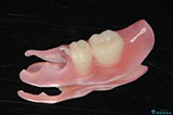 金属床義歯